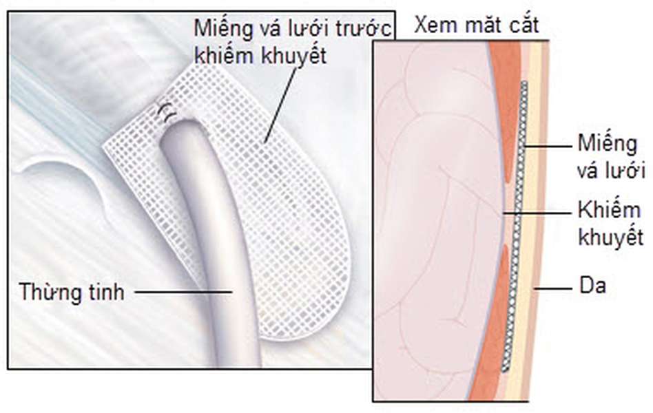 Ảnh 3 của Incisional hernia